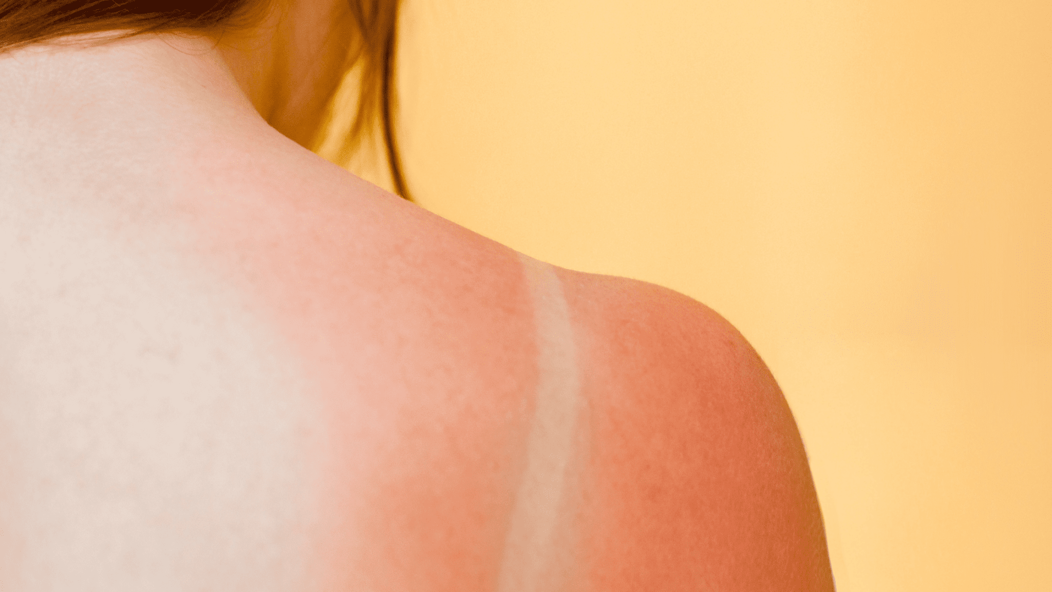 Can CBD Help Your Sunburn?