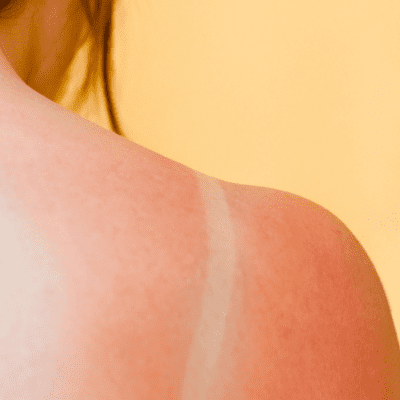 Can CBD Help Your Sunburn?